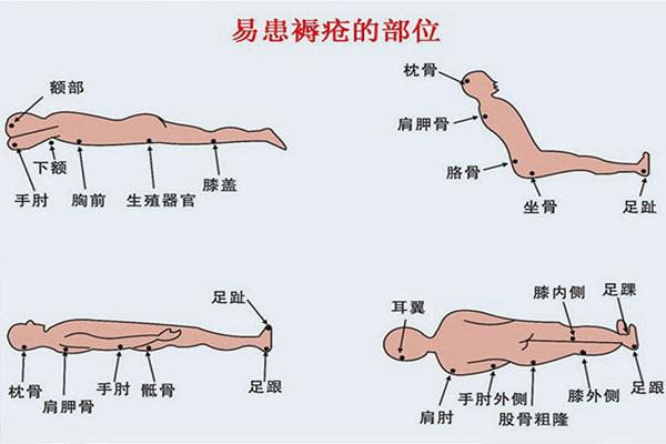 家庭必備護(hù)理常識(shí)丨冬季褥瘡高發(fā)，長(zhǎng)期臥床老人如何預(yù)防褥瘡？